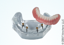 Zahnimplantat Locator für dritte Zähne