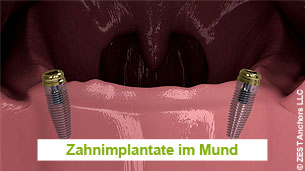 Locator Zahnimplantate im Mund